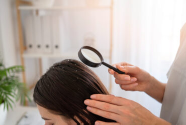 how to get rid of dandruff